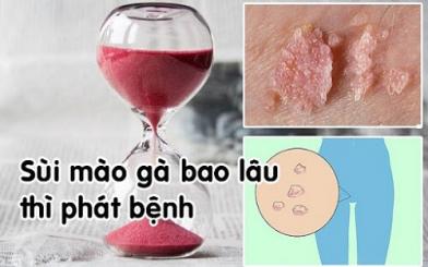 Sùi mào gà bao lâu thì phát bệnh? Dấu hiệu và cách chữa hiệu quả