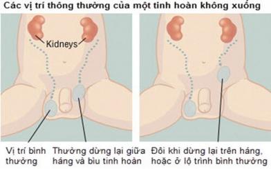 Tinh hoàn lạc chỗ: Nguyên nhân, dấu hiệu và cách điều trị 