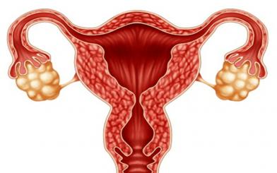 [Hỏi đáp] Tất tần tật về hội chứng buồng trứng đa nang 
