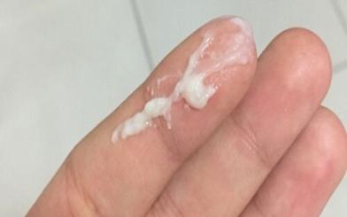 Huyết trắng vón cục có mùi hôi – Tìm cách xử lý triệt để!