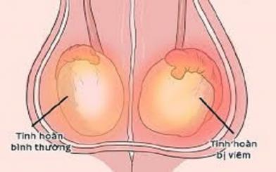 Bệnh viêm tinh hoàn: Nguyên nhân, dấu hiệu, biến chứng và cách chữa