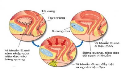 Viêm đường tiết niệu nữ: Cách nhận biết và chữa trị hiệu quả