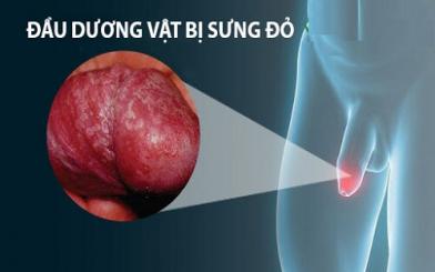 Đầu dương vật bị đỏ là bệnh gì? Cách điều trị hiệu quả