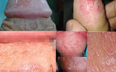 Dương vật bị tróc da: Cảnh báo bệnh tình dục!