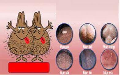 Nổi mụn ở tinh hoàn: Nguyên nhân và cách điều trị hiệu quả