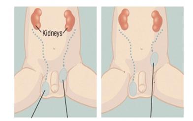 Tinh hoàn bị lệch là bệnh gì? Chữa khỏi không?
