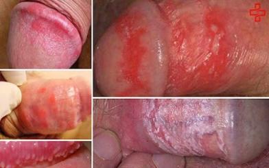 TOP các bệnh viêm nhiễm dương vật nam giới dễ mắc