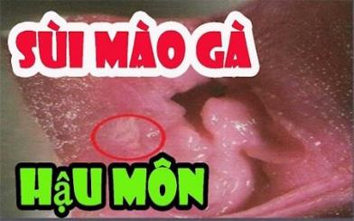  Sùi mào gà ở hậu môn rất nguy hiểm, bạn biết chưa?
