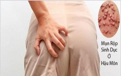 Mụn rộp sinh dục ở hậu môn: Nguyên nhân, triệu chứng & cách điều trị 