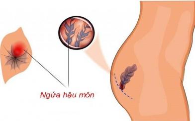 [ Giải Đáp ] Tại sao bị trĩ lại ngứa hậu môn & cách khắc phục