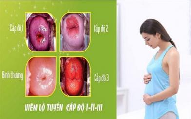 [GIẢI ĐÁP] Viêm lộ tuyến cổ tử cung có mang thai được không?