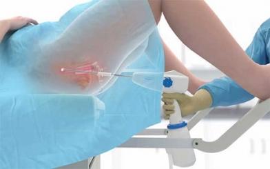 Chữa viêm lộ tuyến cổ tử cung bằng áp lạnh là gì? Có nên thực hiện không?