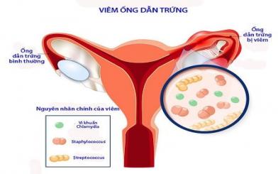 Bệnh viêm ống dẫn trứng: Nguyên nhân, dấu hiệu, chẩn đoán và cách điều trị hiệu quả