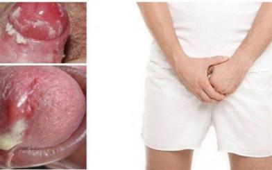 Bệnh lậu ở nam giới có nguy hiểm không? Chữa được không?