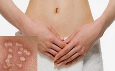 Cẩn trọng với hiện tượng mụn rộp sinh dục bị vỡ