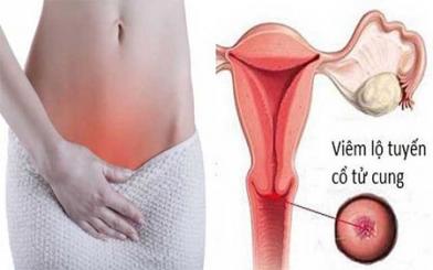 [ Giải Đáp ] Viêm lộ tuyến cổ tử cung 3cm có gây nguy hiểm không?