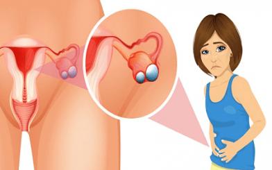 [Cảnh báo] U nang buồng trứng gây rối loạn kinh nguyệt hay không?