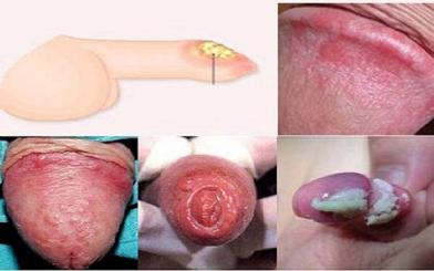 [ Tổng hợp ] 10+ dấu hiệu viêm bao quy đầu điểm hình nam giới nên biết
