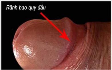 Viêm rãnh bao quy đầu: Nguyên nhân và 3 cách điều trị hiệu quả