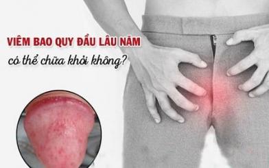 [ Giải Đáp ] Viêm bao quy đầu có chữa được không và bằng cách nào ?