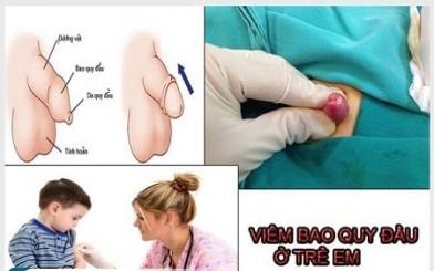 [Giải đáp] Viêm bao quy đầu ở trẻ bôi thuốc gì hiệu quả và an toàn ?