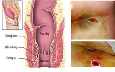 [ Tổng hợp ] 5+ triệu chứng rò hậu môn dễ nhận biết nhất hiện nay