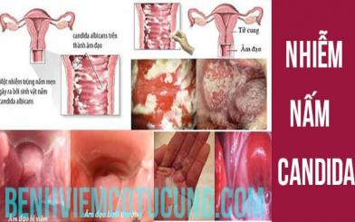 Nhiễm nấm Candida : Nguyên nhân, triệu chứng và cách chữa hiệu quả