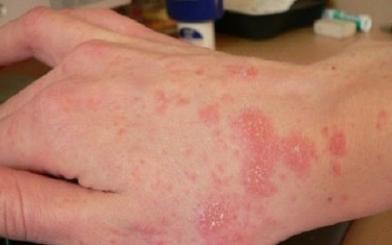 [ Review ] Kinh nghiệm chữa nấm Candida theo từng giai đoạn