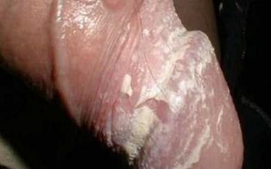 [ Tổng hợp ] Hình ảnh nấm Candida ở nam giới chi tiết theo từng giai đoạn
