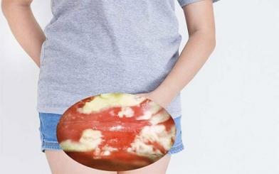 [ Giải Đáp ] Nấm candida có lây không và 3 cách chữa hiệu quả nhất