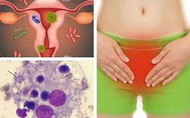 [ Giải Đáp ] Thời gian ủ bệnh nấm Candida là bao lâu và bệnh có nguy hiểm không ?