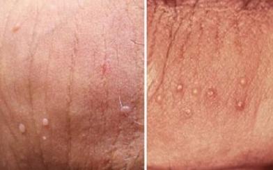 [ Tổng hợp ] 10+ dấu hiệu sùi mào gà ở nam giới dễ nhận biết hiện nay