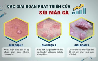 [ Giải Đáp ] Thời gian ủ bệnh sùi mào gà trong bao lâu và dấu hiệu nhận biết