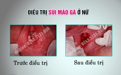 [ Review ] Hình ảnh sau khi đốt sùi mào gà có hết và để lại seo không ?