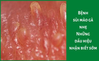 Bệnh sùi mào gà nhẹ : Nguyên nhân, triệu chứng và cách điều trị hiệu quả