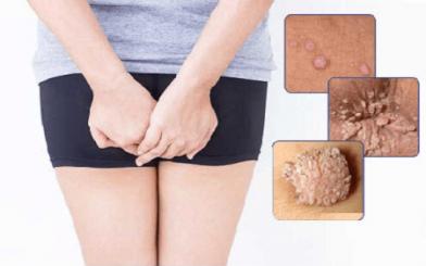 Sùi mào gà trong hậu môn là gì ? Nguyên nhân, triệu chứng và cách điều trị hiệu quả
