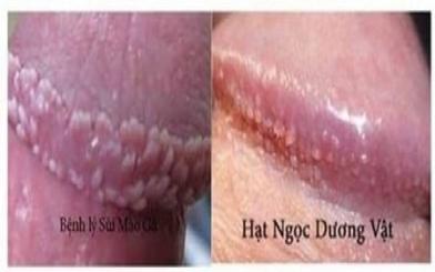 [ Phân Biệt ] Sùi mào gà và chuỗi hạt ngọc bằng các dấu hiệu nhận biết