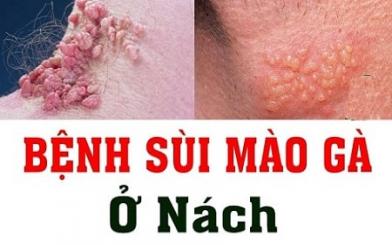 [ Giải Đáp ] Sùi mào gà có mọc ở nách không và sự nguy hiểm của bệnh