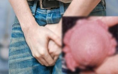 [ Tìm hiểu ] Sùi mào gà ở rãnh bao quy đầu có nguy hiểm không và chữa như nào ? 