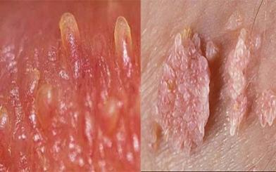 [ Giải Đáp ] Sùi mào gà ngứa 2 bên mép vùng kín nguy hiểm không ?