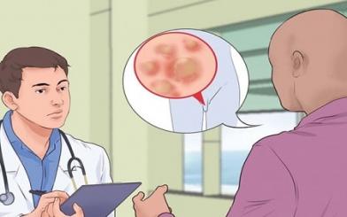 [ Giải Đáp ] Sùi mào gà giai đoạn đầu có chữa khỏi không và thời gian bao lâu ?