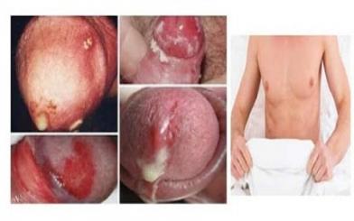 [ Tổng hợp ] 10+ Dấu hiệu bệnh lậu dễ nhận biết ở nam giới và nữ giới