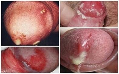 [ Review ] Hình ảnh bệnh lậu ở nam giới và nữ giới theo từng giai đoạn