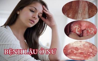 Bệnh lậu ở nữ giai đoạn đầu : Nguyên nhân và cách điều trị hiệu quả hiện nay