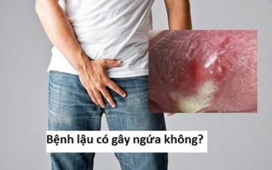 [ GIải Đáp  ] Bệnh lậu có ngứa không và chữa bằng cách nào hiệu quả ?