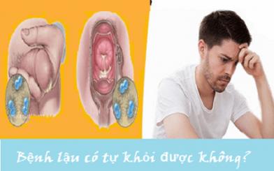 [ Cập Nhật 2023 ] Phác đồ điều trị bệnh lậu hiệu quả cao hiện nay