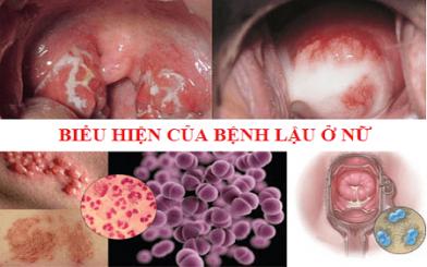 [ Tổng hợp ] 10+ dấu hiệu phát hiện bệnh lậu giai đoạn cuối