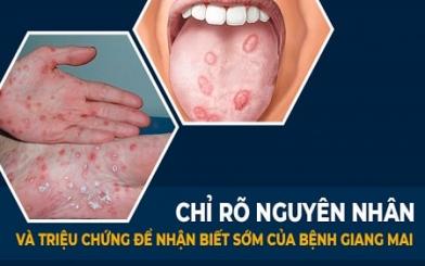 Bệnh giang mai : Nguyên nhân, triệu chứng và cách điều trị hiệu quả