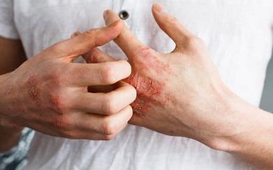 Giang mai giai đoạn 1 : Nguyên nhân, triệu chứng và cách điều trị hiệu quả
