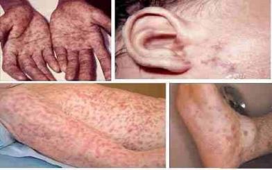 Bệnh giang mai ở nữ : Nguyên nhân, triệu chứng và cách điều trị hiệu quả
